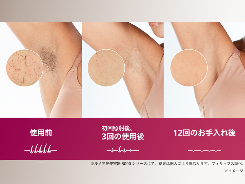 使い続けることで、太い毛も目立ちにくくなる*