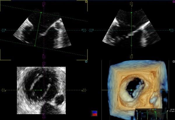 超音波画像のクローズアップ