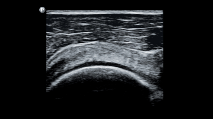 回旋腱板／肩関節（L12 4）