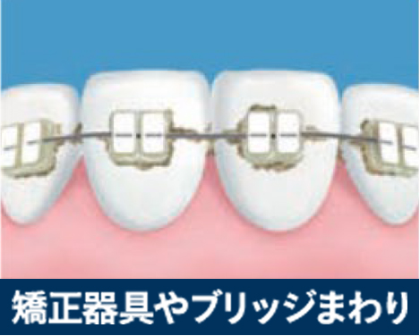 矯正器具やブリッジ周りに歯垢が溜まっているイメージ